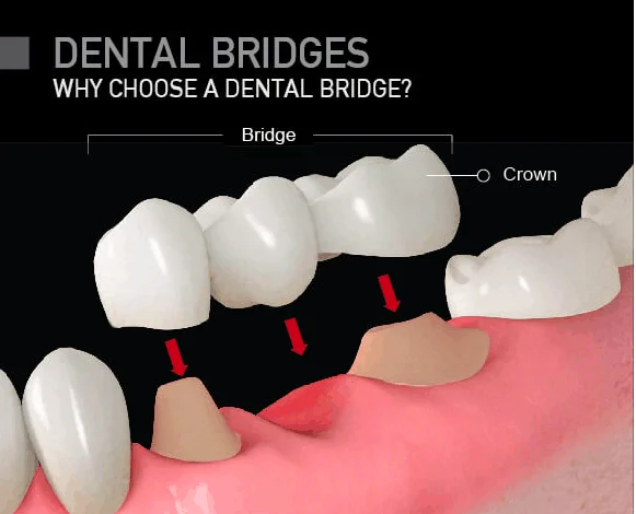 What is a Dental Bridge?