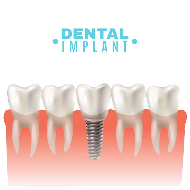 dental implant procedure 