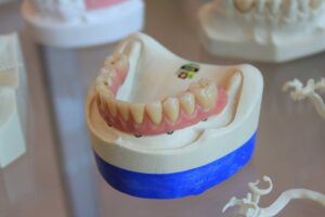 Dental Bridges Are the Ideal Solution for Missing Teeth