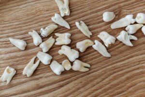 Pain-Free Root Canal Treatment 1
