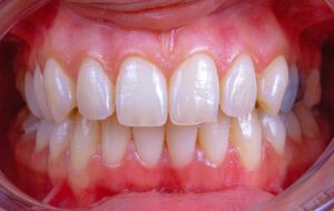 Prevent Gum Disease